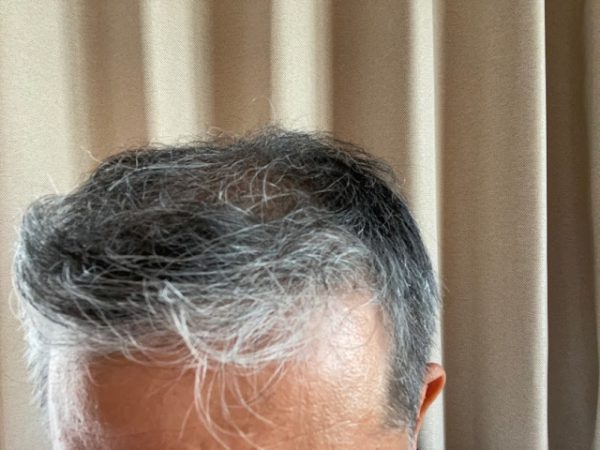 ハゲって遺伝するのか？親がハゲてたらハゲるなら何しても無理ゲーなんじゃない？